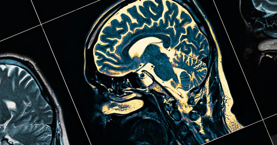Dementia-MRI